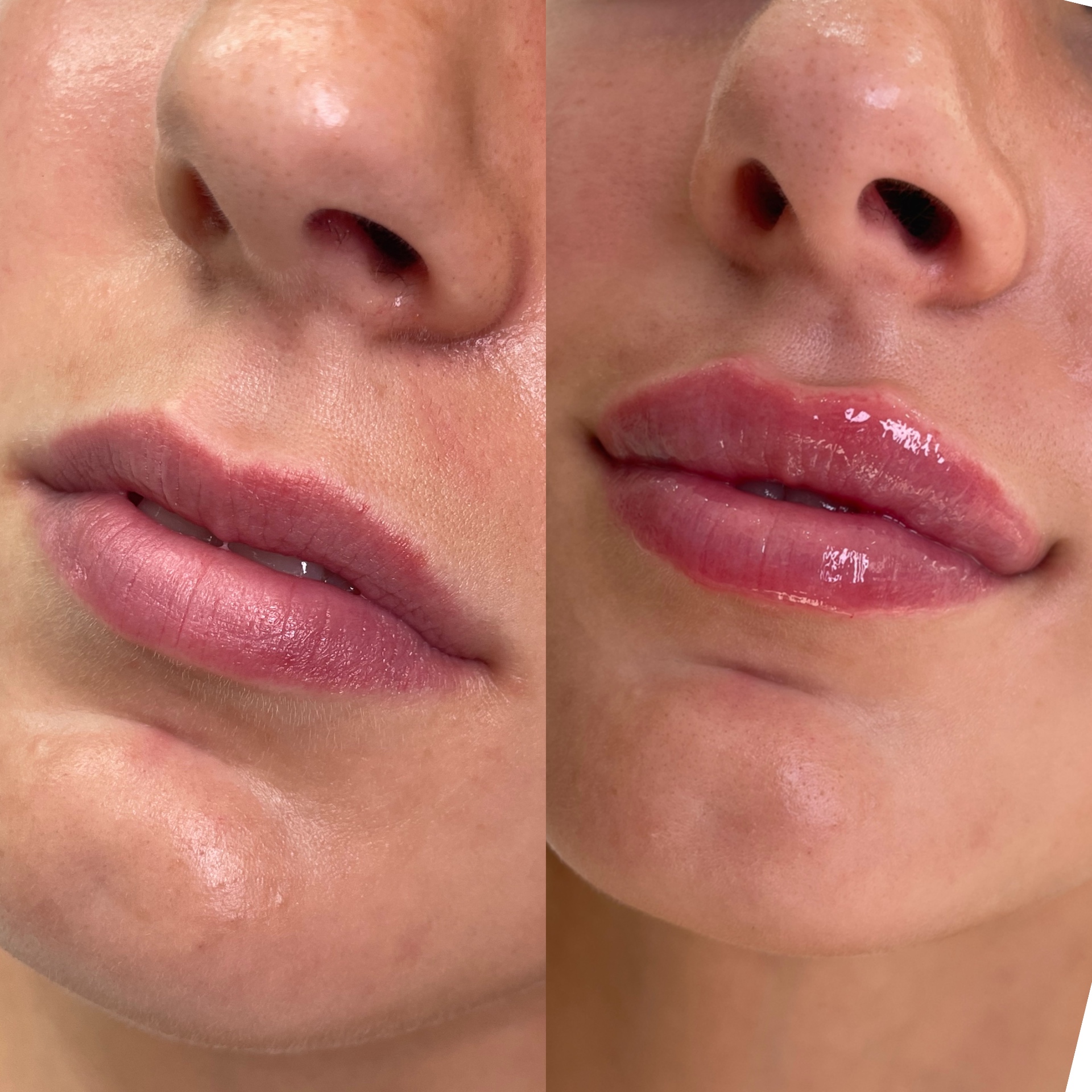 Lip filler before and after at Glossed, showing balanced volume and a defined lip border