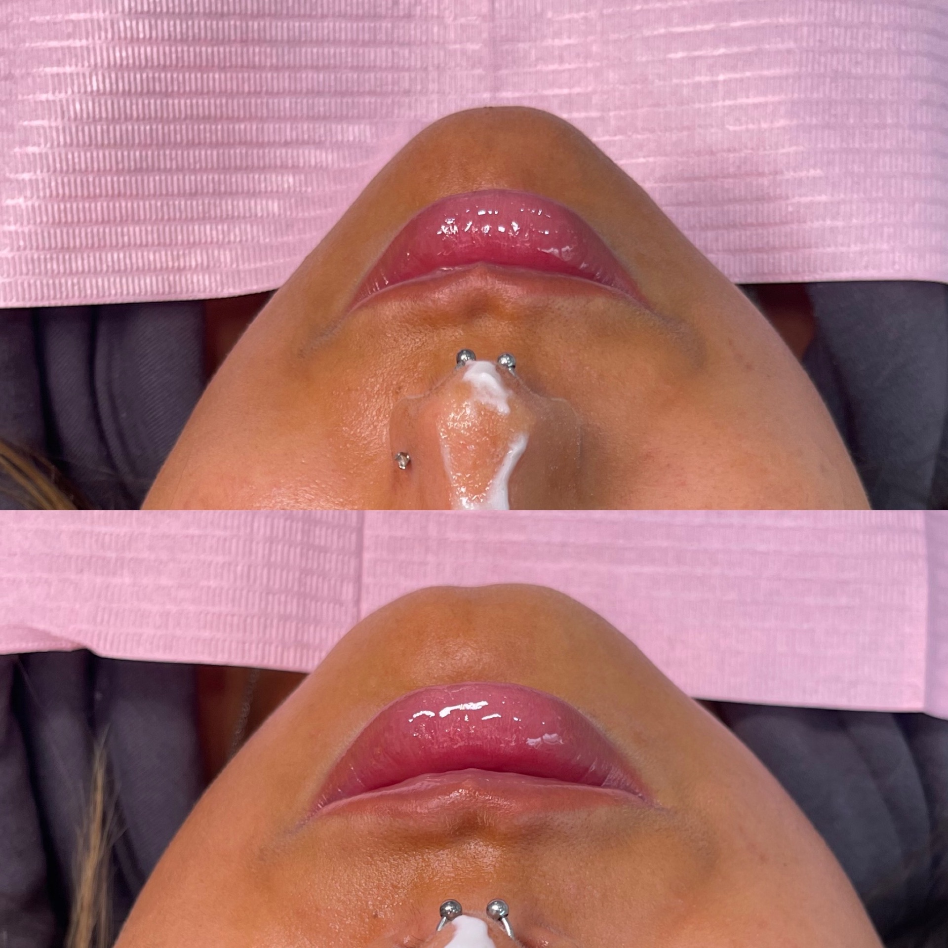 Glossy, hydrated lips immediately after lip filler at Glossed