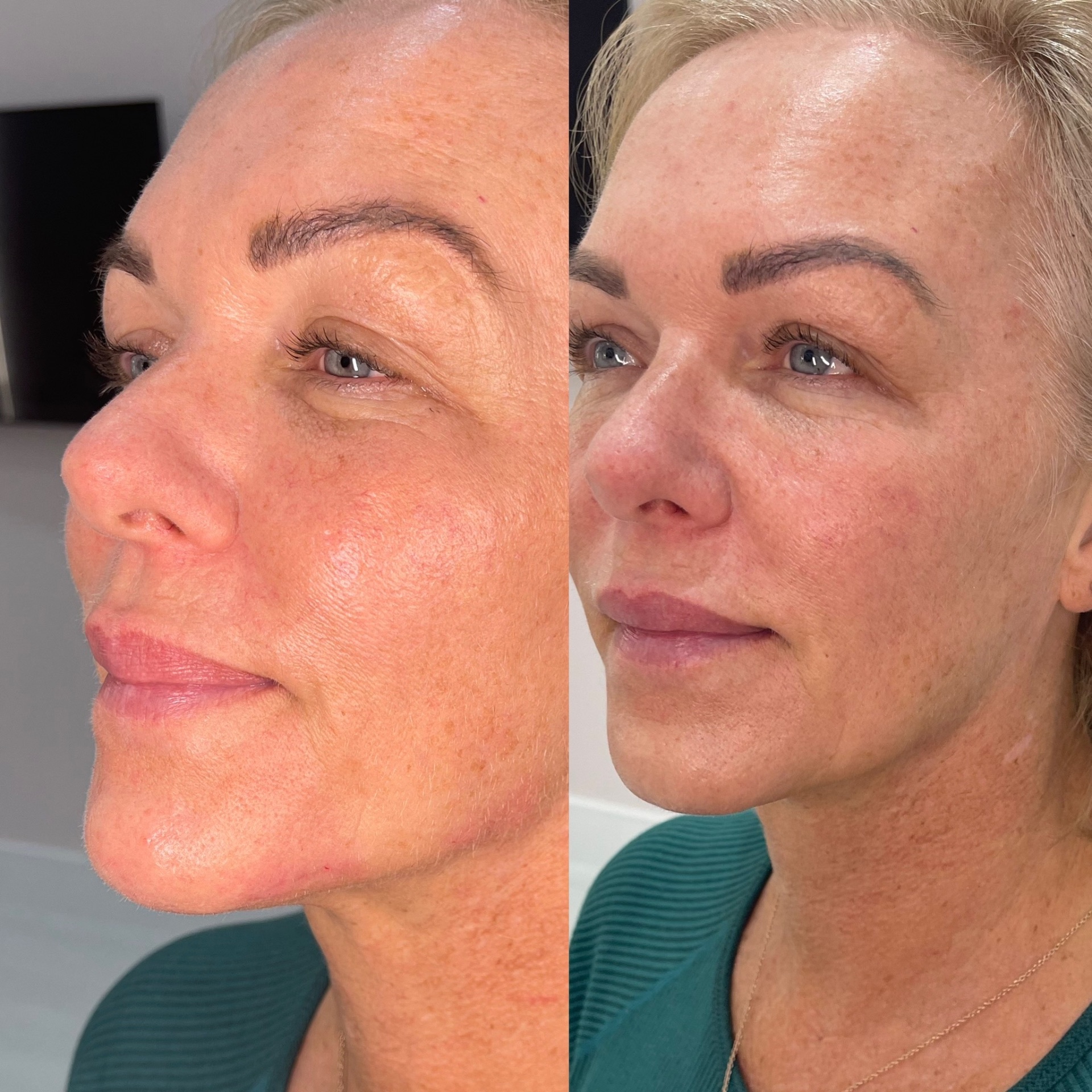Skin rejuvenation before and after showing smoother texture and reduced redness