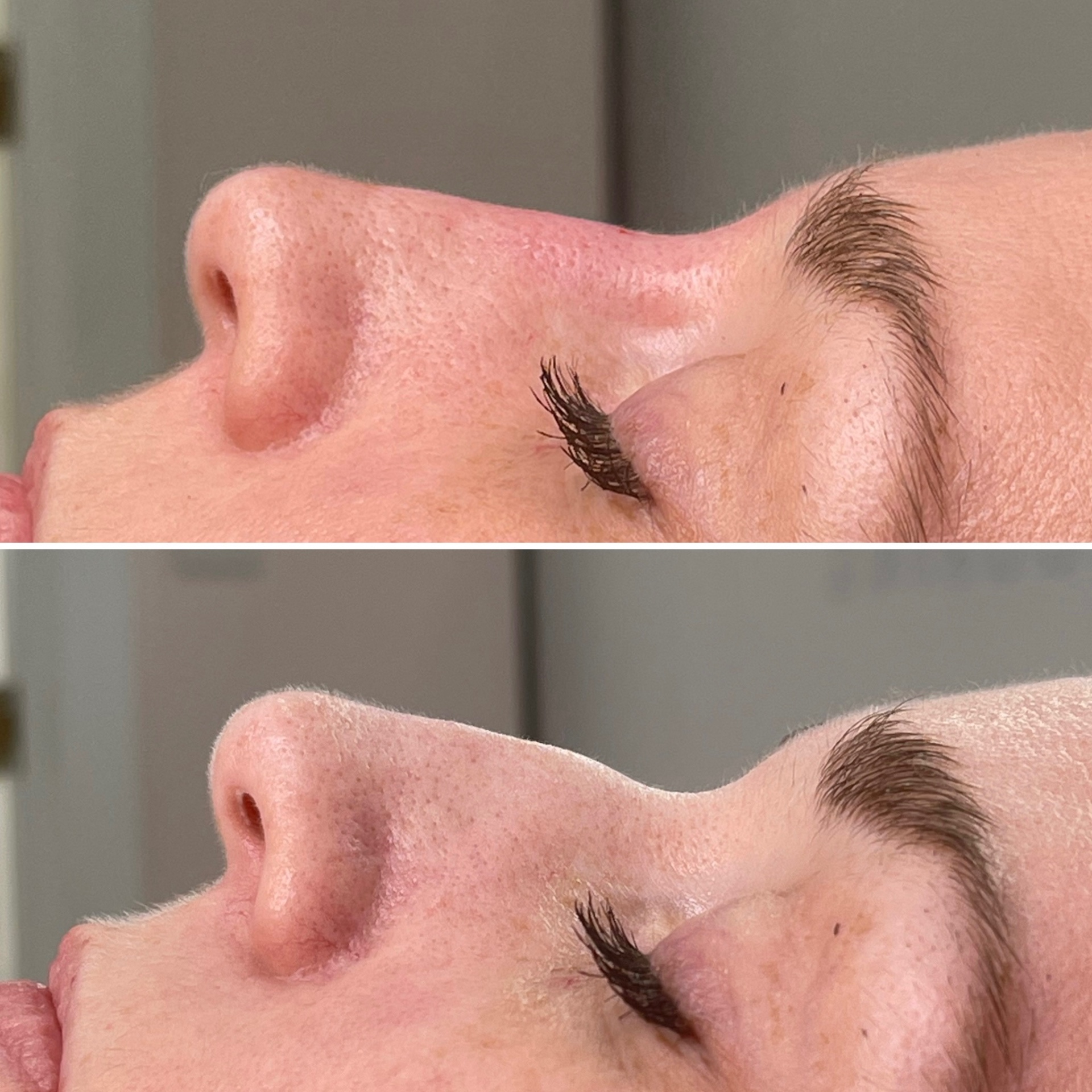 Skin texture and pore refinement before and after a course of facials at Glossed