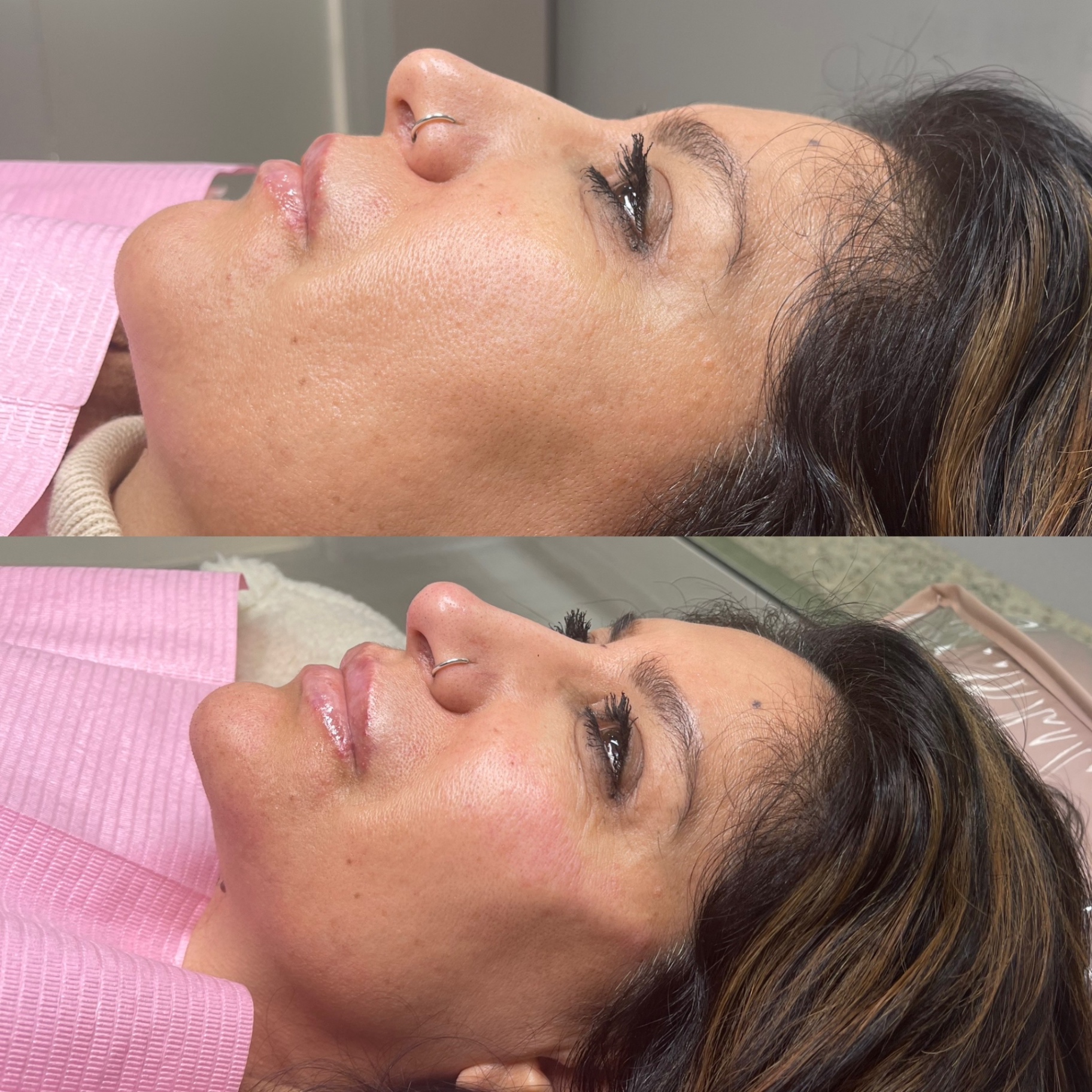 Nose profile before and after non-surgical refinement at Glossed