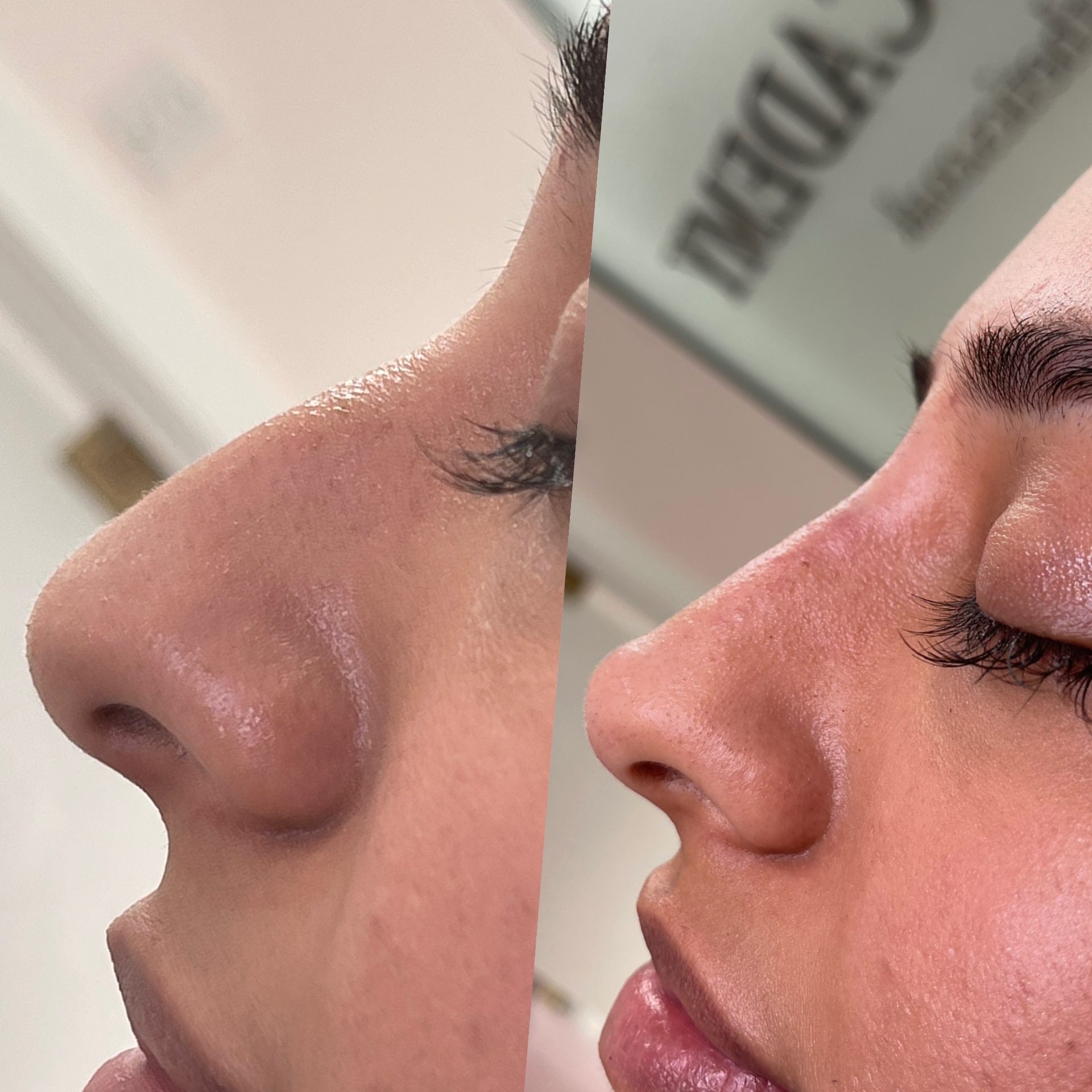 Non-surgical nose refinement before and after at Glossed, showing a smoother profile